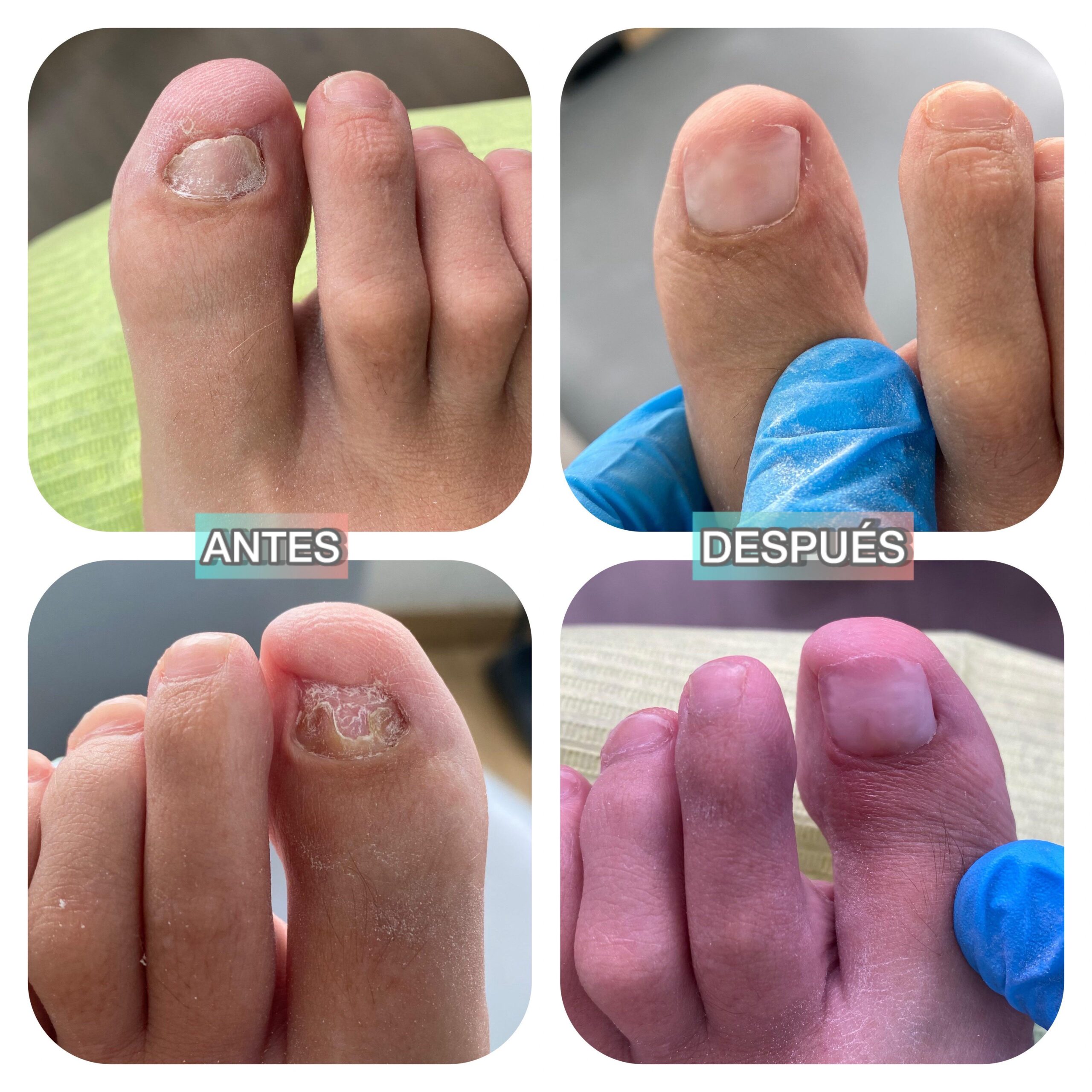 uñas-reconstruccion.jpg Reconstrucción de uñas