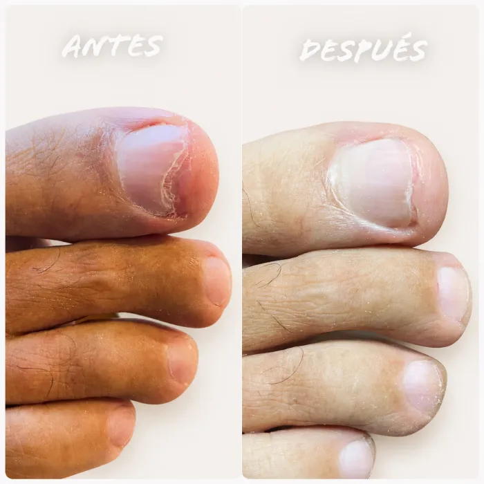Uña del pie con hongos (onicomicosis) antes del tratamiento en Sevilla