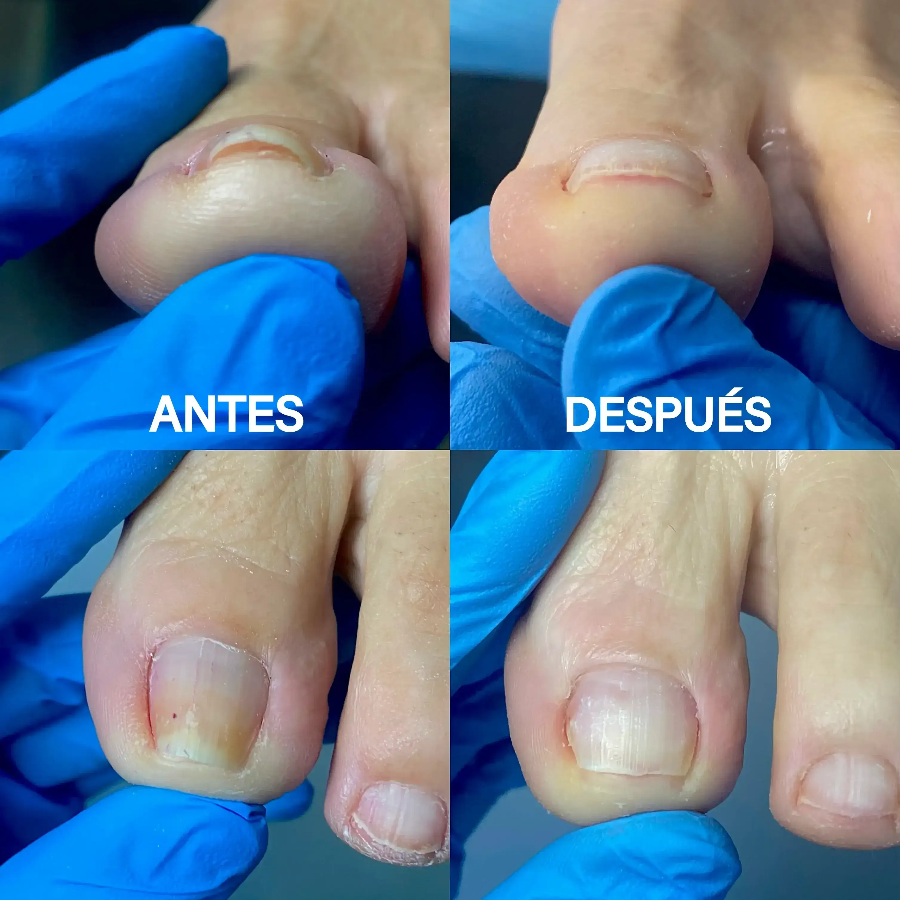 Antes y después de resultado de ortonixia realizado por Irene García Ventura en Sevilla