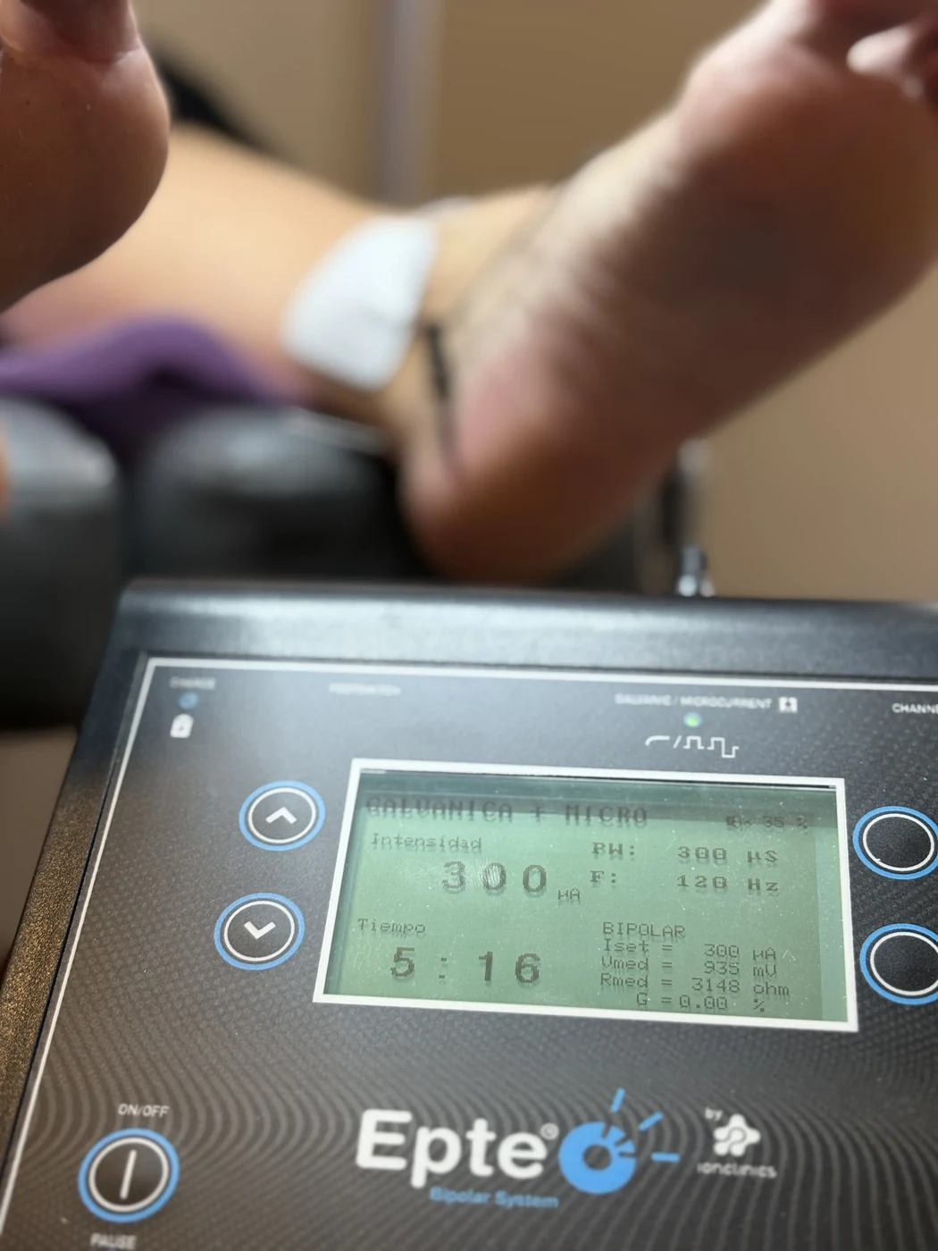 Tratamiento de fascitis plantar con electroterapia EPTE en Sevilla