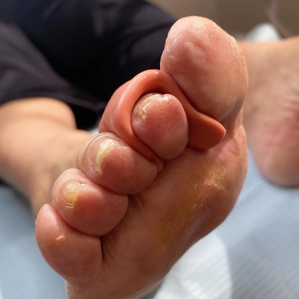 Prótesis de silicona para dedo en garra
