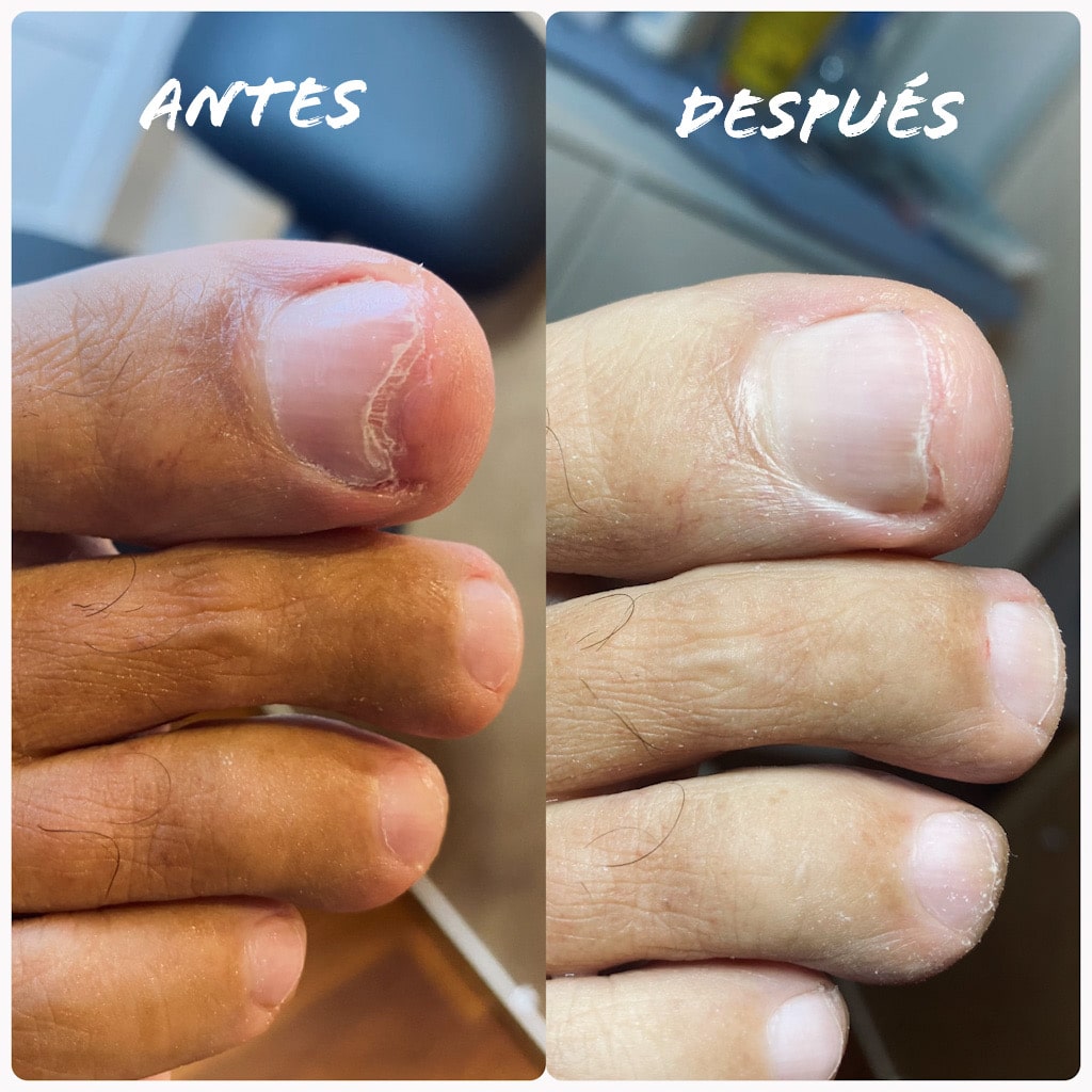 Tratamiento para hongos en las uñas