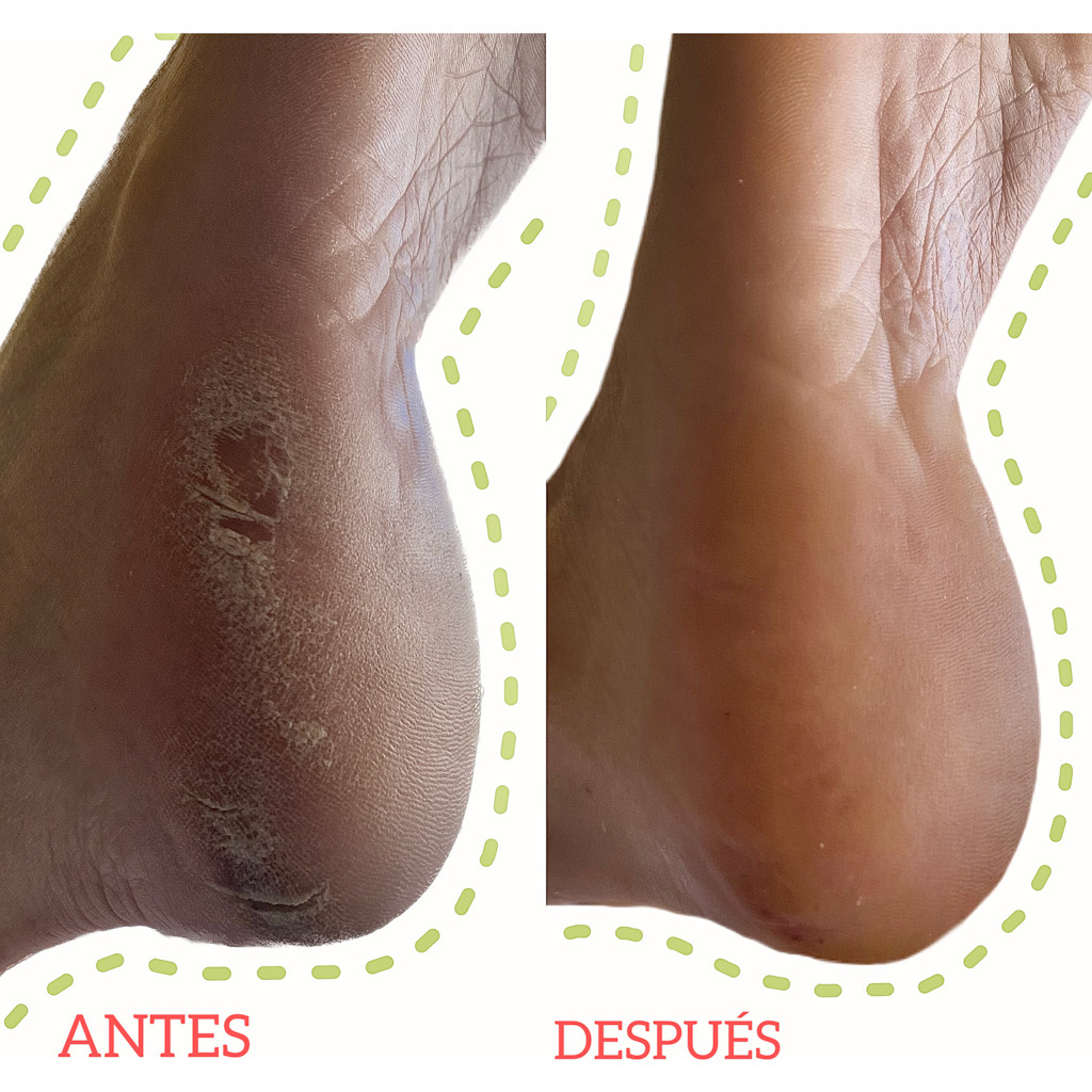 Grietas en el talón por sequedad