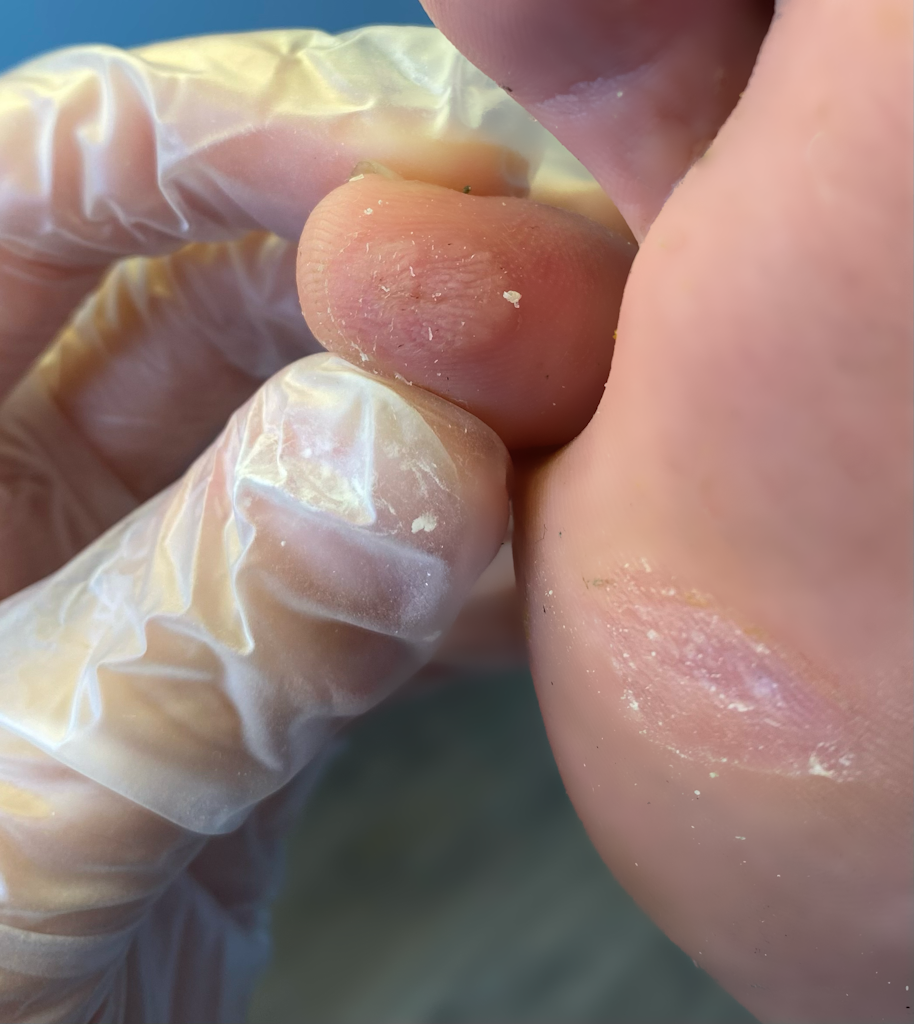 Tratamiento del papiloma en el dedo del pie