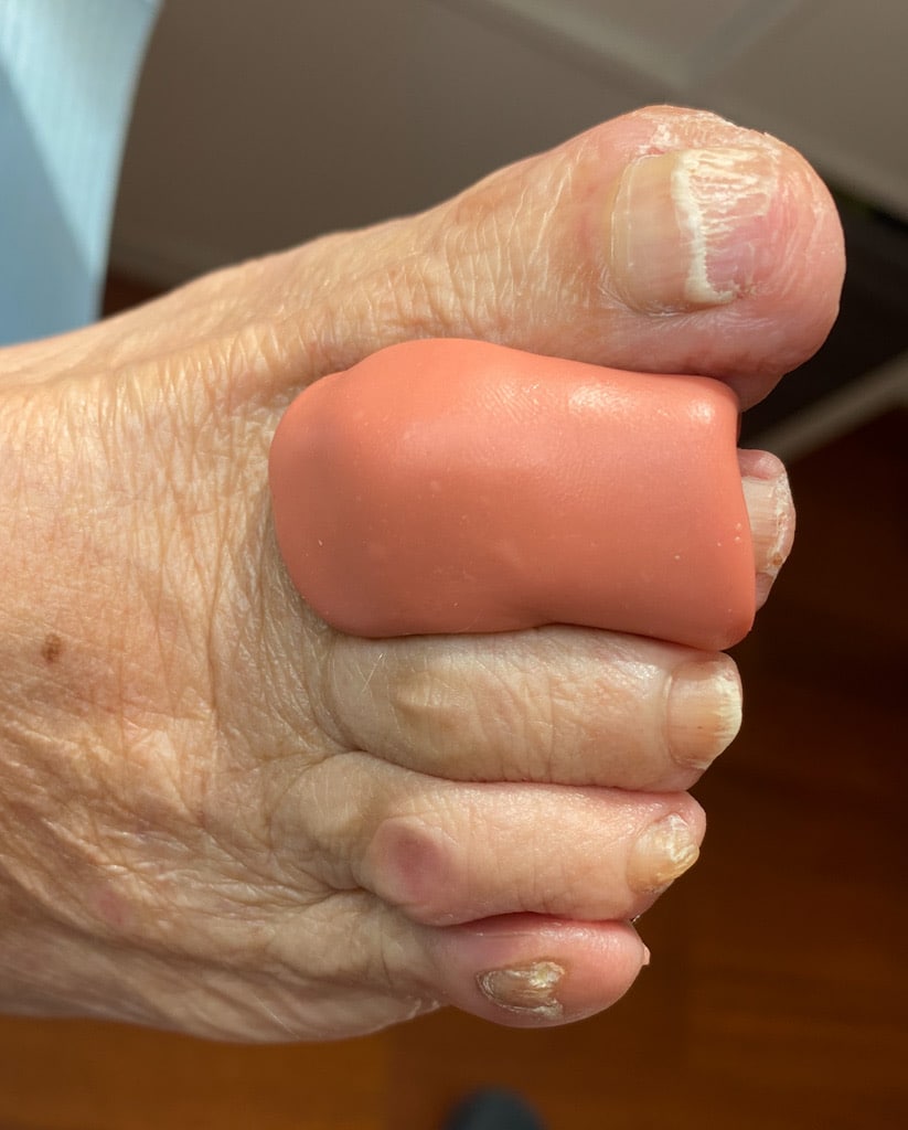 Separador de silicona para dedos deformados