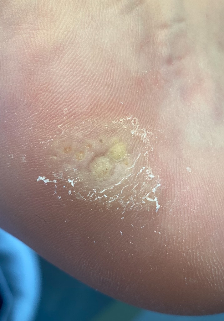 Verruga plantar también conocido como papiloma en el pie