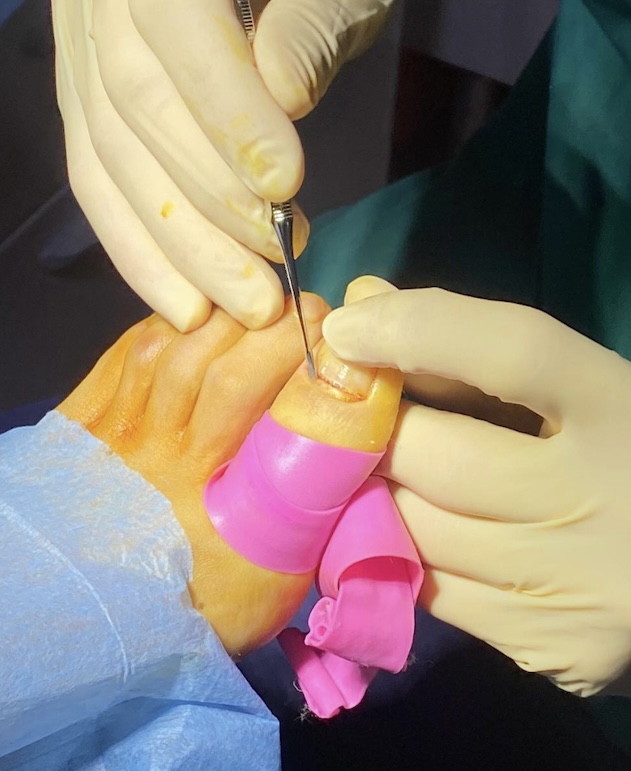 Cirugia para uñas encarnadas